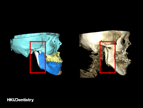 Intraoral vertical ramus osteotomy (IVRO): (Left) The pre-operative virtual surgical planning (red frame); (Right) The post-operative CT scan (red frame). 